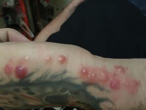 Servere allergic reaction to bedbugs