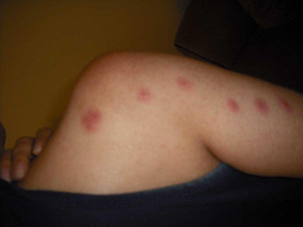 bed bugs black spots