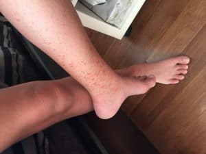 bedbug sores on feet